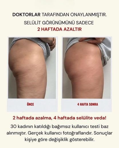 3'lü etkili Lipödem, Selülit, Varis Taytı